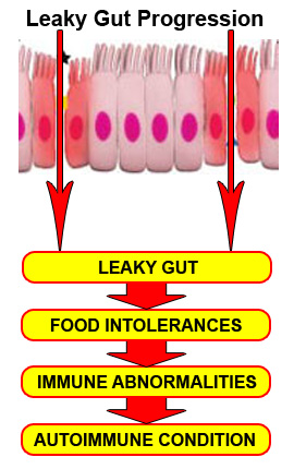 A diagram showing leaky gut progression: from leaky gut, to food sensitivities, to immune abnormalities, to an autoimmune condition. The sooner the better in terms of healing a leaky gut.