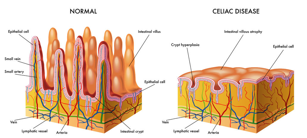 Diagram showing normal intestinal villi compared to villous atrophy, which is characteristic of celiac disease. A test called an intestinal biopsy can reveal whether villous atrophy is present.